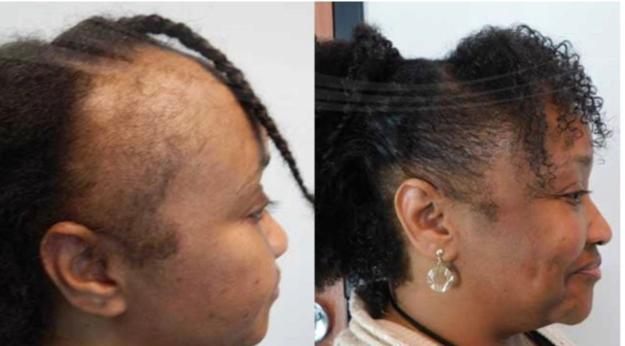 Batana Oil (Dr.Sebi Approved Hair growth Miracle Oil For Alopecia)