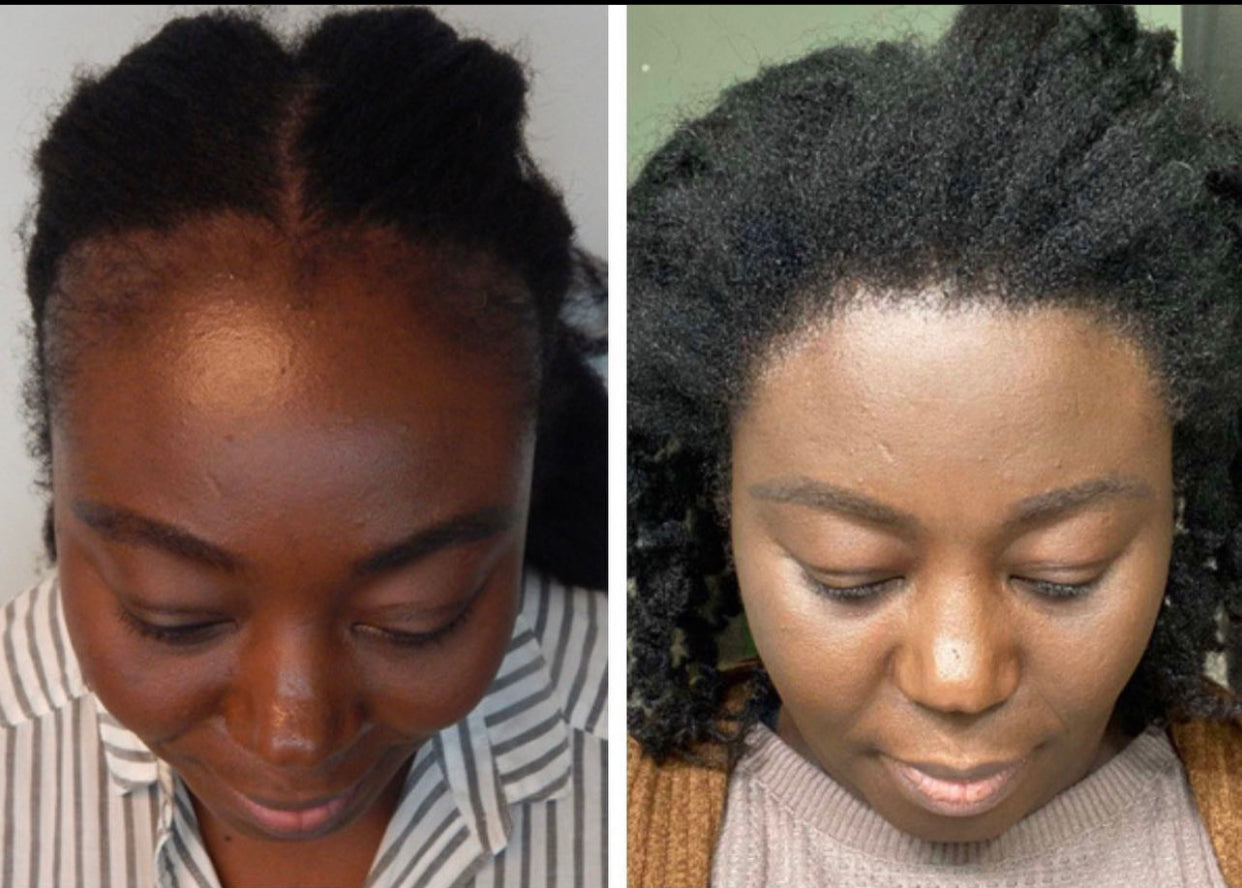 Batana Oil (Dr.Sebi Approved Hair growth Miracle Oil For Alopecia)